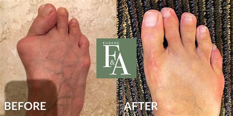 Bunion Pain Relief | Stages & Treatment | Eugene Foot & Ankle