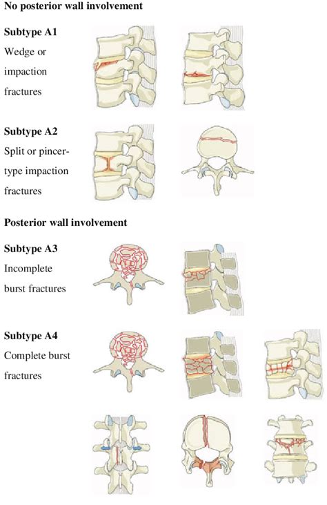 Type-A compression injuries of the vertebral body | Download Scientific Diagram