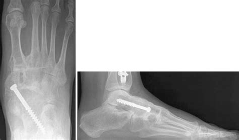 Midfoot Arthritis: Nonoperative Treatment and Arthrodesis | Musculoskeletal Key