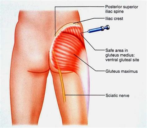 Intramuscular injection – Artofit