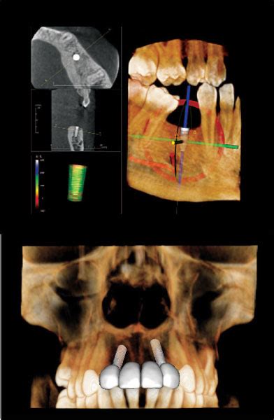 Cone Beam 3D Imaging | Dental Implants | Lynnwood Periodontics ...