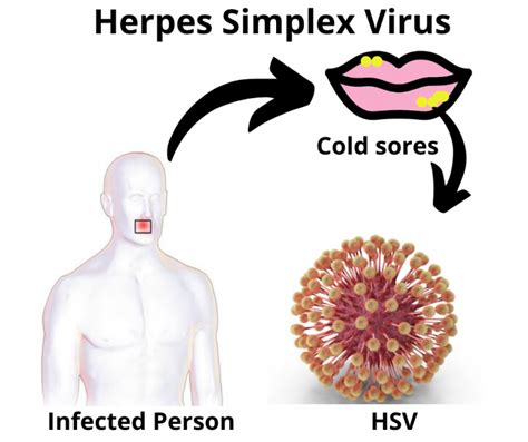 Herpes Simplex Virus: Types, Causes, and Treatment