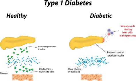 Causes of Type 1 Diabetes