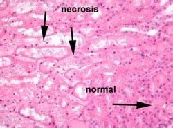 Pathology definition - Acute Tubular Necrosis - Medical Zone