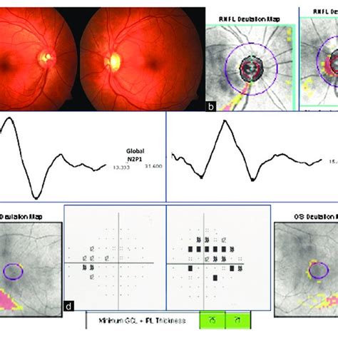 A case with early glaucoma in the right eye with inferior retinal nerve... | Download Scientific ...