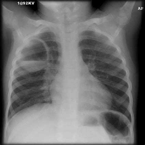 Pneumatocele causes, symptoms, diagnosis, treatment & prognosis