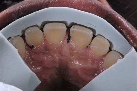 Ceramic Veneers: Tooth Preparation for Enamel Preservation