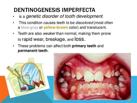 Image result for dentinogenesis imperfecta | Dental assistant, Oral pathology, Dentistry