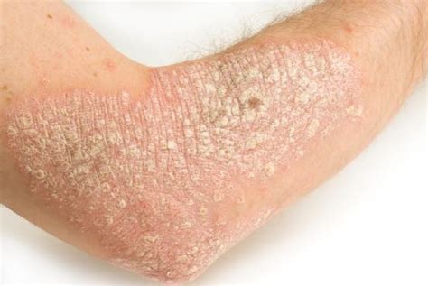 Rash on Arms and Legs, Itchy, Red, Causes, Small Bumps, Pictures, Not Itchy, Skin Rash on Arms ...