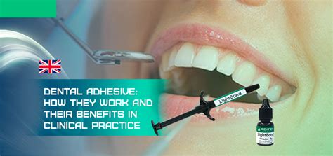 Dental Adhesives: How they Work and their Benefits in Clinical Practice