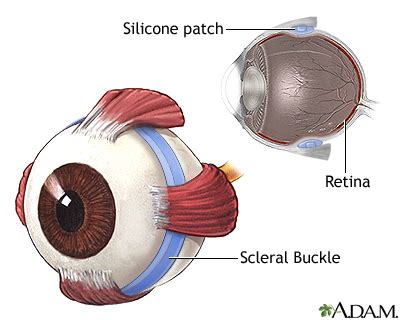 Retinal detachment repair - series—Procedure, part 3: MedlinePlus ...