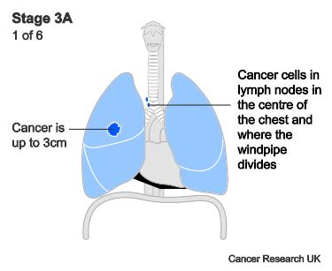 Stage 3 lung cancer | Cancer Research UK