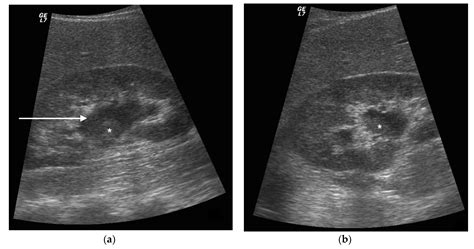 Pyonephrosis Ultrasound and Computed Tomography Features: A Pictorial Review