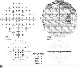 Visual field interpretation | Ento Key