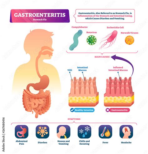 Gastroenteritis vector illustration. Labeled stomach inflammation scheme Stock Vector | Adobe Stock