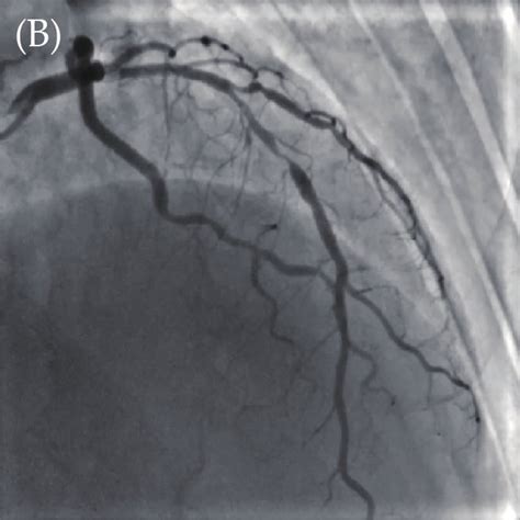 Coronary angiography results. Coronary angiography showed long and... | Download Scientific Diagram