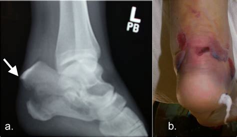 Intra-articular tongue-type fractures of the calcaneus: anatomy, injury ...