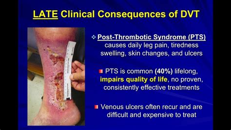 Dr. Vedanthem- Update on Post Thrombotic Syndrome - YouTube