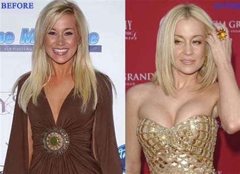 Kellie Pickler Plastic Surgery Photo Before and After | Plastic surgery ...