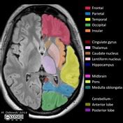 Playlist 'UOE MB2 Neuroanatomy P1 S4' by UoE Radiology