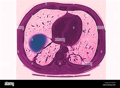 PULMONARY INFARCTION CT SCAN Stock Photo - Alamy