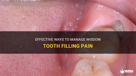 Effective Ways To Manage Wisdom Tooth Filling Pain | MedShun