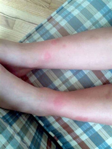 Understanding and Treating Cellulitis from Bug Bites (photos)