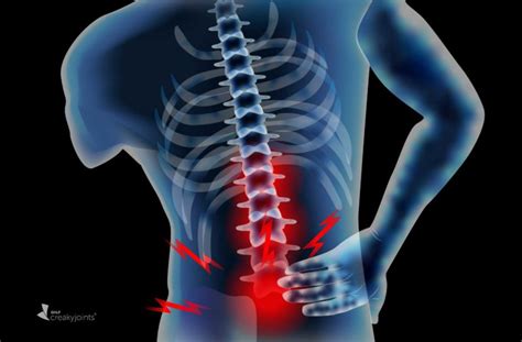 Few Non-Radiographic Axial Spondyloarthritis Patients End Up with Spine ...