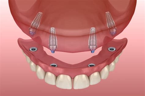 Recovery Tips After an Implant Supported Dentures Procedure - Carolina Smiles Family Dental ...