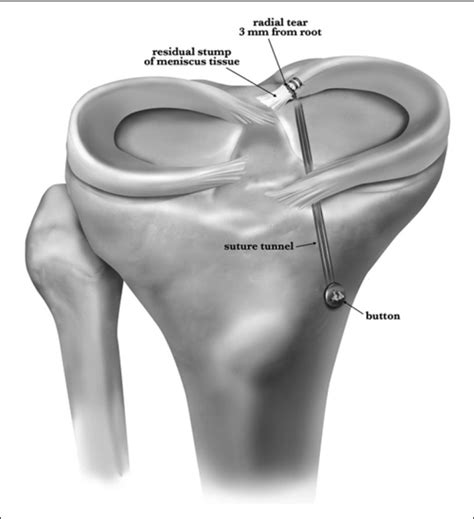 —illustration of transtibial repair of a posterior horn medial meniscal... | Download Scientific ...