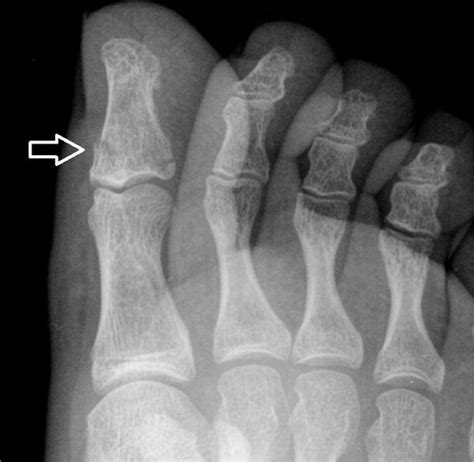 SUSPECTED BROKEN TOES SHOULD BE X-RAYED