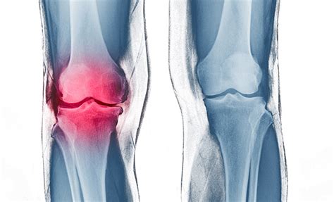 Artroscopia de rodilla: definición, tratamiento y pronóstico | Amorós