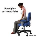 Spondyloarthropathy - Definition, Symptoms, Causes, Treatment