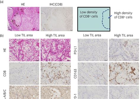 Histology of primary renal cell carcinoma. (a) Low magnification of ...