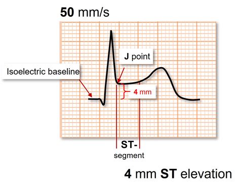 The ST-segment