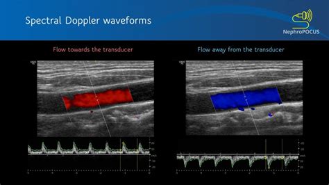 Basics of Doppler Ultrasound for the Nephrologist- Part 2 - Renal Fellow Network