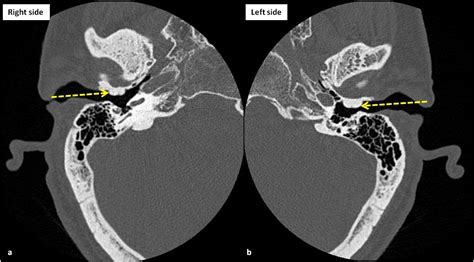 Cureus | Bilateral External Auditory Exostoses Causing Conductive Hearing Loss: A Case Report ...