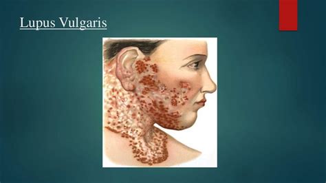 Cutaneous tuberculosis