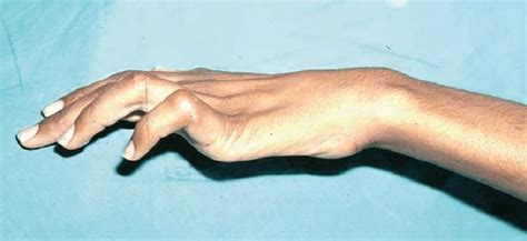 Hand with ulnar claw due to neuritis in Leprosy. | Download Scientific ...