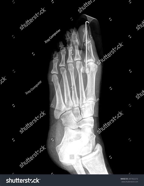 Film Xray Show Fracture Proximal Phalange Stock Photo 287352272 ...