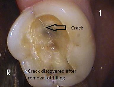 [진주치과] 금 간 치아(Cracked tooth)의 치료방법 : 네이버 블로그