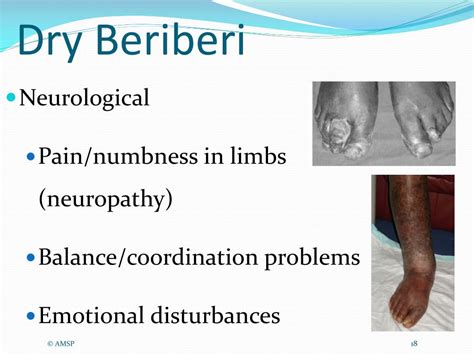 PPT - NUTRITIONAL DEFICIENCY & ALCOHOL USE DISORDERS PowerPoint ...