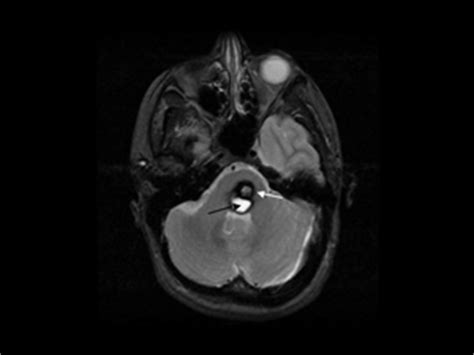 Cavernoma Surgery | Best Cavernoma Surgeon | Cavernous Malformation ...