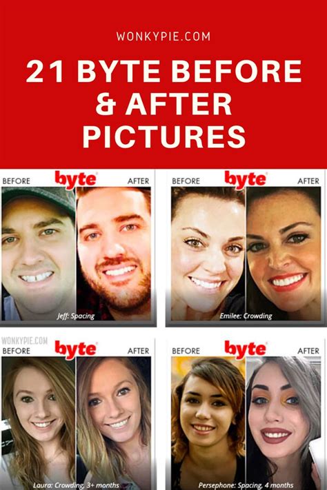 Byte Aligners: 21 Before & After Photos (Pics of Real Results!) | Teeth straightening, Byte ...