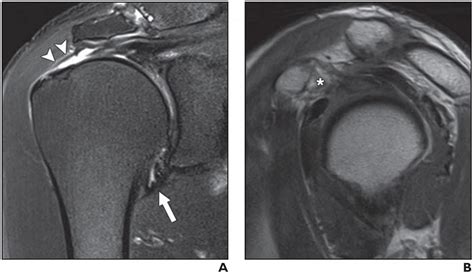 Supraspinatus Tear Mri