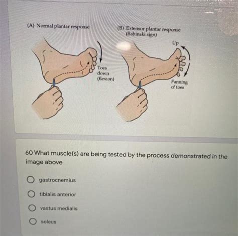 Solved (A) Normal plantar response (B) Extensor plantar | Chegg.com