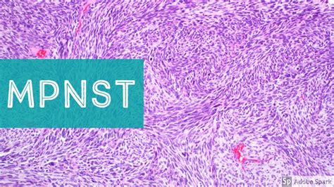 Mpnst Histology