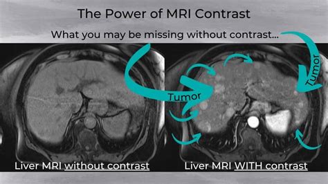 Gadolinium Mri Contrast