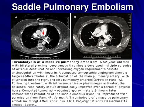 What Kind Of Doctor Does Pulmonary Embolism Treatment - 49 Personalized ...