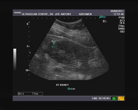 Ultrasound imaging: Sonography of angiomyolipoma: